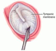 myringotomy /my�rin�got�o�my/ 