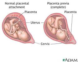 Placenta previa - via Daymix