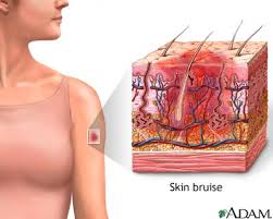 A  bruise  occurs when a force