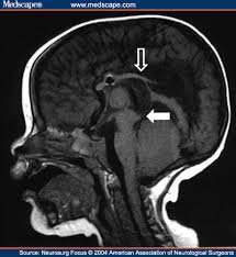 The  tectum   is beaked closed arrow    