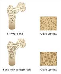 Osteoporosis - via Daymix