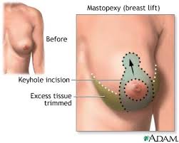  Breast -revision surgery is