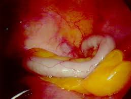 A purpose for your appendix