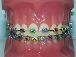 Tags: Beugelbekkies, Braces
