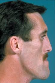  Acromegaly .