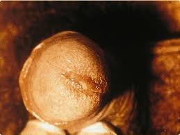 File:SOA-Chlamydia-trachomatis - via Daymix