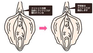 ているクリトリス包皮を切除