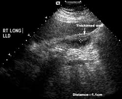 http://www.meddean.luc.edu/lumen/MedEd/Radio/curriculum/Surgery/cholecystitis3.jpg