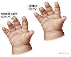  Aarskog syndrome  or fetal
