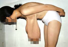 肥大