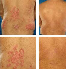  Psoriasis  infliximab.