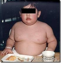 Prader Willi Syndrome | The Morning News