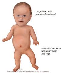 http://www.lucinafoundation.org/assets/achondroplasia.jpg