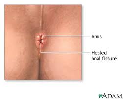 Anal fissure