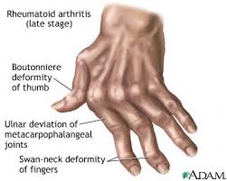 Rheumatoid  arthritis 