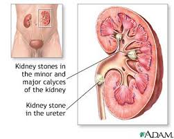  Kidney stones 
