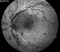 http://www.ophthalmologyweb.com/Images/Miscellaneous/Factor_V_Leiden.jpg