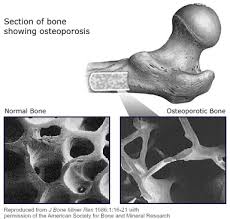 Osteoporosis - via Daymix