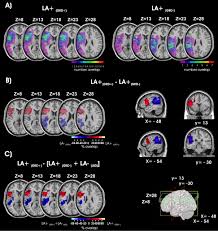 patients with limb  apraxia 