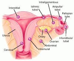 Ectopic Pregnancy - via Daymix
