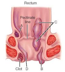 hemorrhoid hem or rhoid