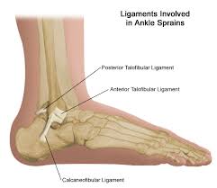 Sprains or  strains  are