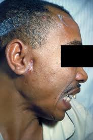 http://upload.wikimedia.org/wikipedia/commons/9/98/Actinomycosis_PHIL_2856_lores.jpg