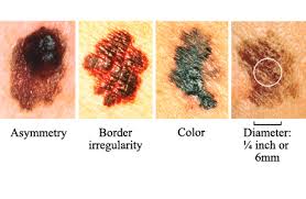 ABCDEs of melanoma  skin cancer 