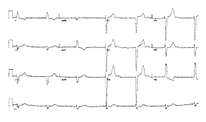 http://www.ecglibrary.com/ecgs/af_chb3.gif