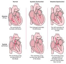  Heart Failure 