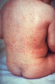 Hiv-rash | Chennai Outfits
