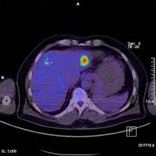   PET scan   CT  scan PET   CT  scan  