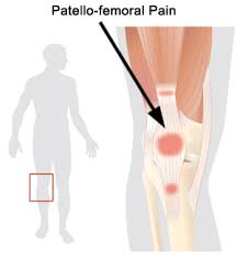  Anterior Knee Pain 