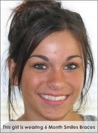 6 month smile six month braces