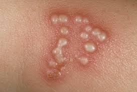  herpes simplex 