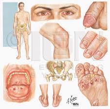 So let's discuss chlamydia, - via Daymix