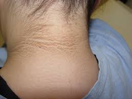 What is  acanthosis nigricans ?
