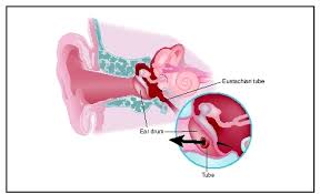  who need a myringotomy and tube 