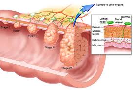 off breast cancer. Chemo - via Daymix