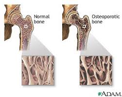 Osteoporosis - via Daymix