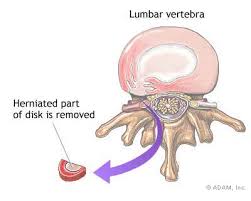 Most  slipped  disks ( herniated 