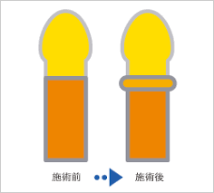 ペニスリング法