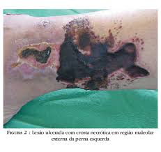 http://www.scielo.br/img/revistas/abd/v83n2/a11fig2.jpg