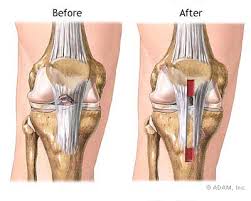  ACL reconstruction  is usually
