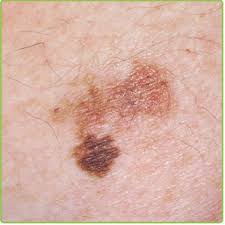 Details nodular  melanoma 