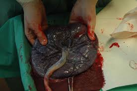Placenta with cord. - via Daymix