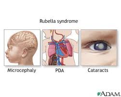 Rubella  Syndrome