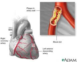  stent placement  -  heart 