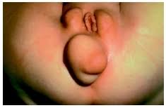  Intersex 