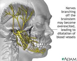  Migraine  cause